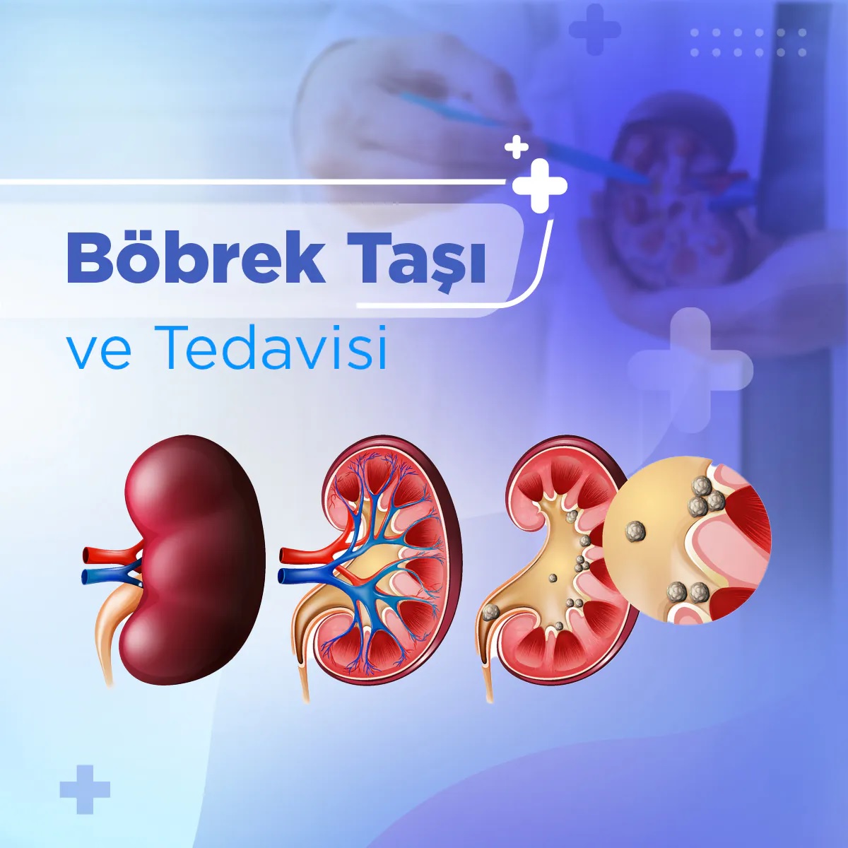 Lazer ile Böbrek Taşı Kırma